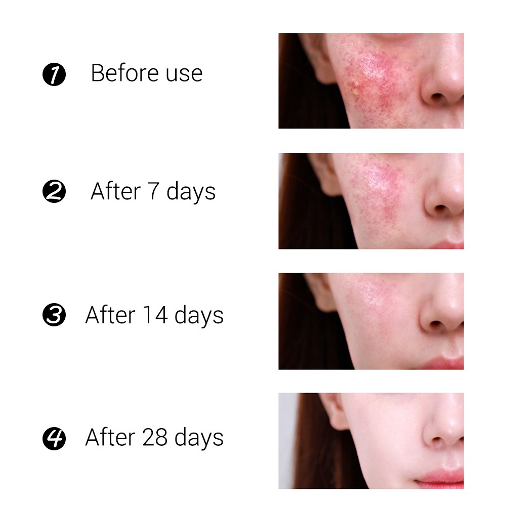 Kem Hỗ Trợ Giảm Pimples Breylee Kiềm Dầu Thu Nhỏ Lỗ Chân Lông 20g / 0.71 floz