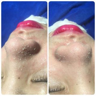 Ủ Mụn Cám Đầu Đen Cao Cấp