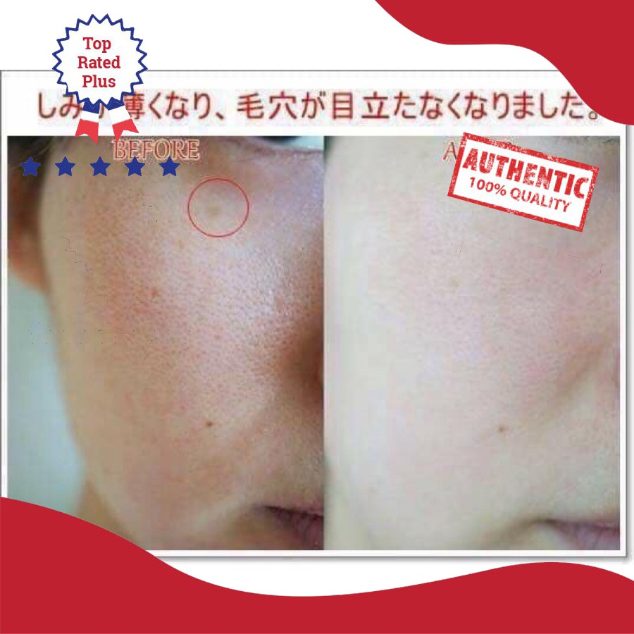 HOTTransamin_500mg - Viên Uống Trị_Nám, Trắng Da Transamin_500mg Nhật Bản
