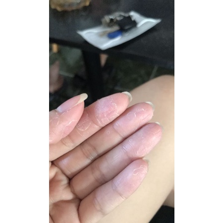 Chàm da,  Bong Tróc da,Ngứa da bàn tay