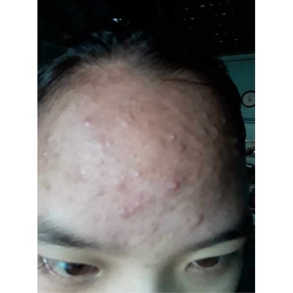 An Kim Tiền_Serum mụn_thể tích 5ml_dung dịch màu đen | BigBuy360 - bigbuy360.vn