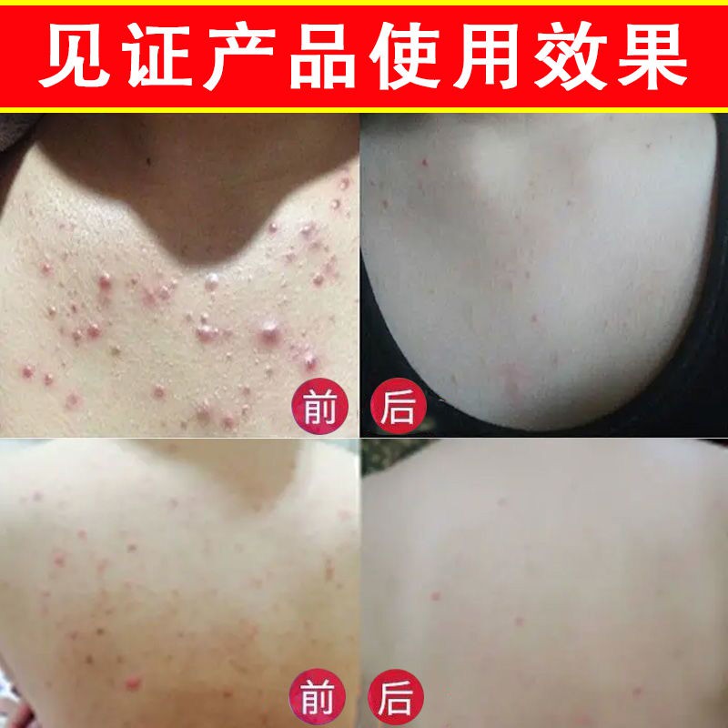 (Hàng Mới Về) Bộ Sản Phẩm Trị Mụn Đầu Đen Liposomes