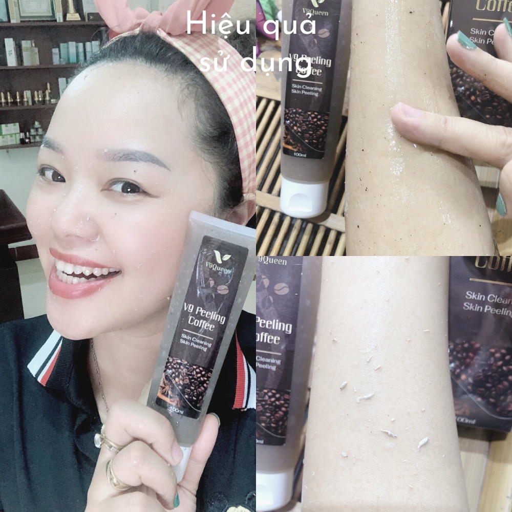 Kem nám tàn nhang V9Queen, bộ mỹ phẩm làm mờ thâm nám tàn nhang dưỡng trắng da