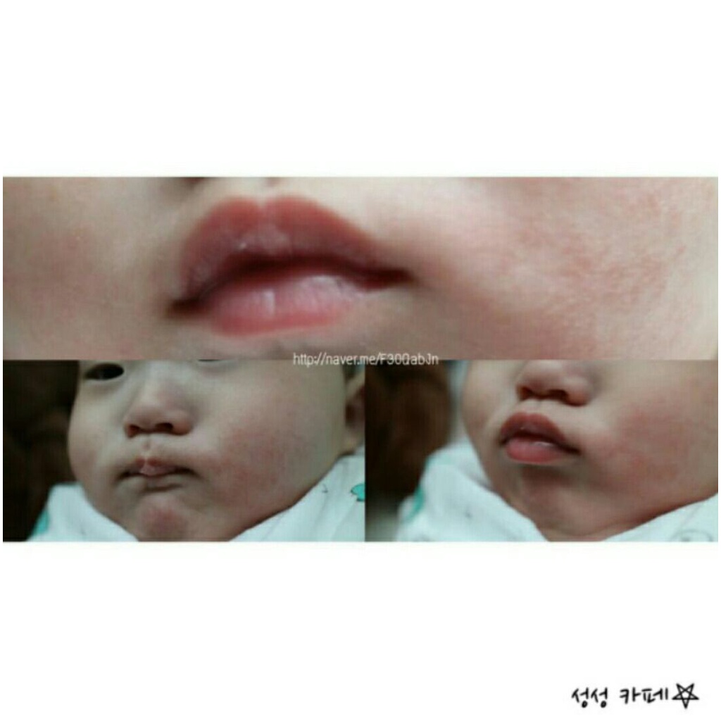 Kem dưỡng da cơ địa chàm sữa Atopalm dung tích 10ml