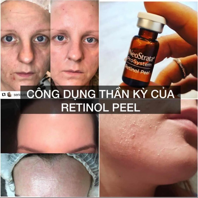 Thay da sinh học NeoStrata ProSystem Retinol Peel