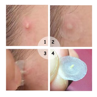BREYLEE Miếng dán Hỗ Trợ Giảm mụn  cao cấp