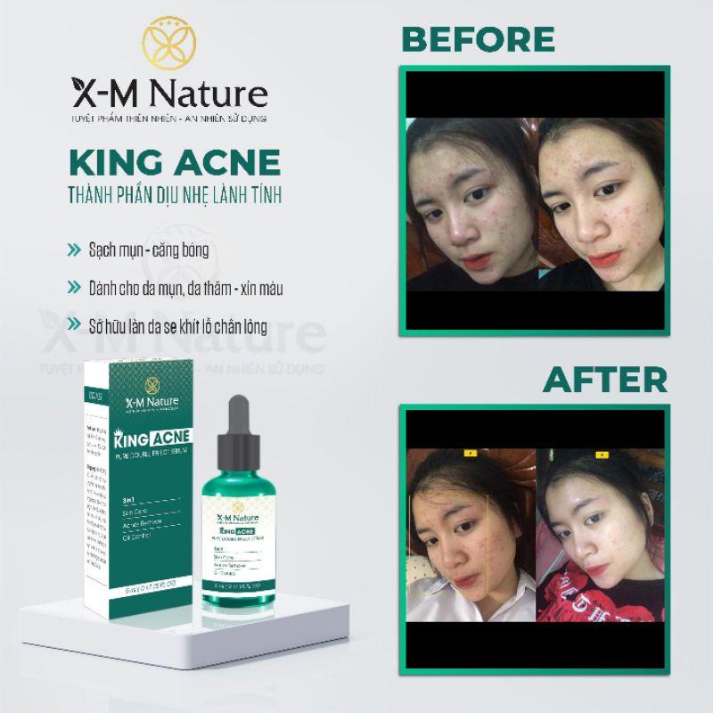 Srum mụn king acne