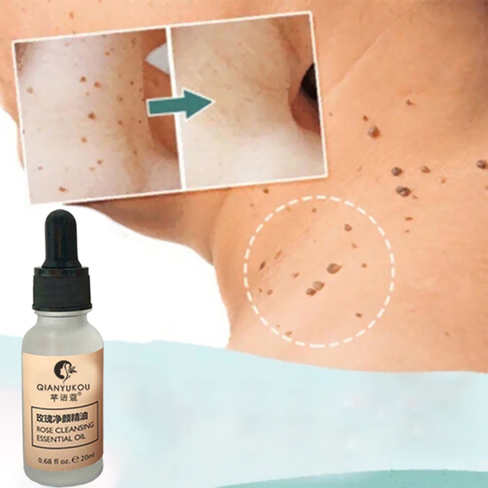 Dung dịch loại bỏ Mole hiệu quả cho da mặt 20ml | BigBuy360 - bigbuy360.vn