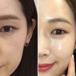 CẤY CHỈ TƠ TẰM Chitossil Hàn Quốc