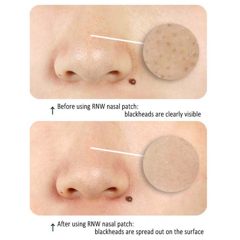 Miếng dán mũi RNW lột mụn đầu đen hai bước
