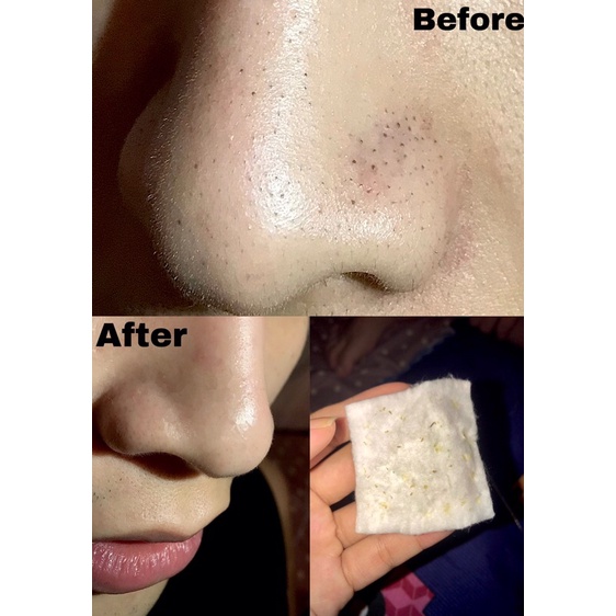 Ủ mụn Medipeel 100ml