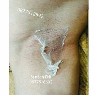 Lột thay da nách xóa thâm hết sạm mịn da