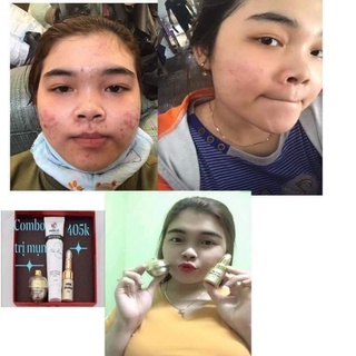 [ Kèm quà] Combo chuyên mụn Huỳnh Đỗ, sạch mụn hết thâm