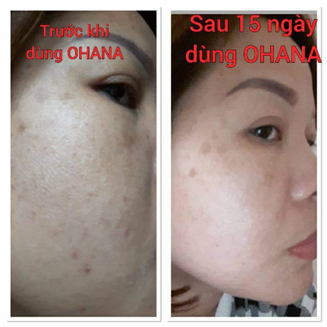 HUYẾT HỒNG SÂM - VUA TRỊ MỤN - TÁI TẠO | BigBuy360 - bigbuy360.vn