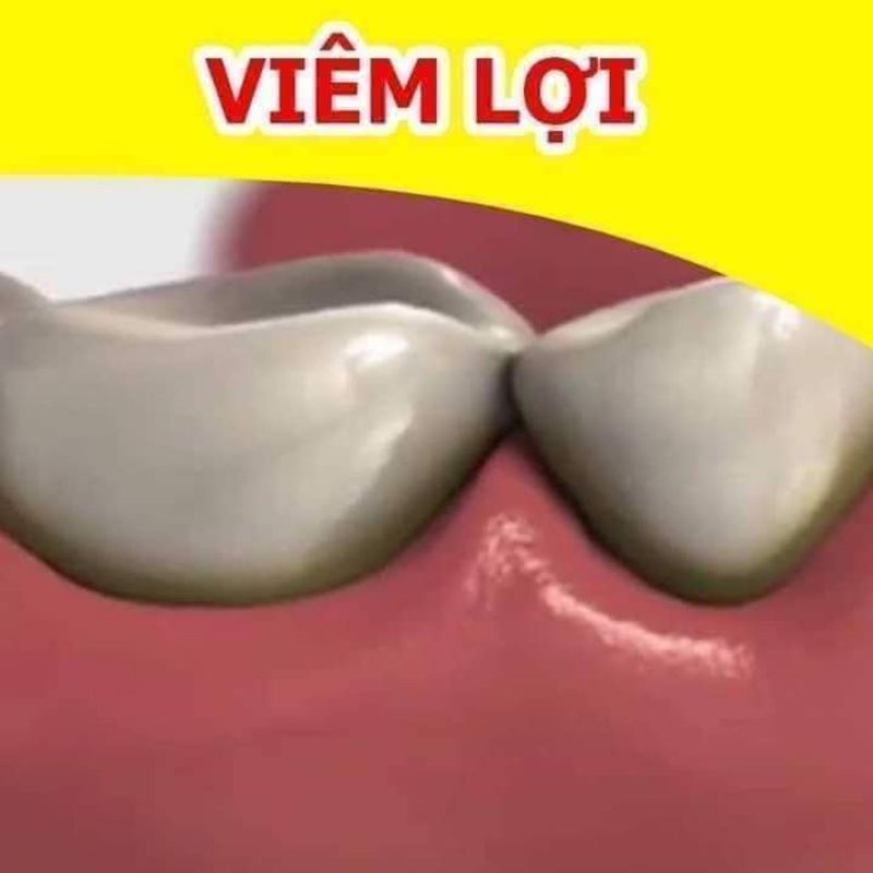 Nước ngậm hết đau răng, hôi miệng  viêm lợi , sản phẩm gia truyền