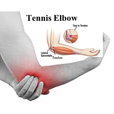 Đai bó cơ khuỷu tay khi chơi Tennis, golf, cầu lông, bóng bàn AOLIKES - Tennis Elbow