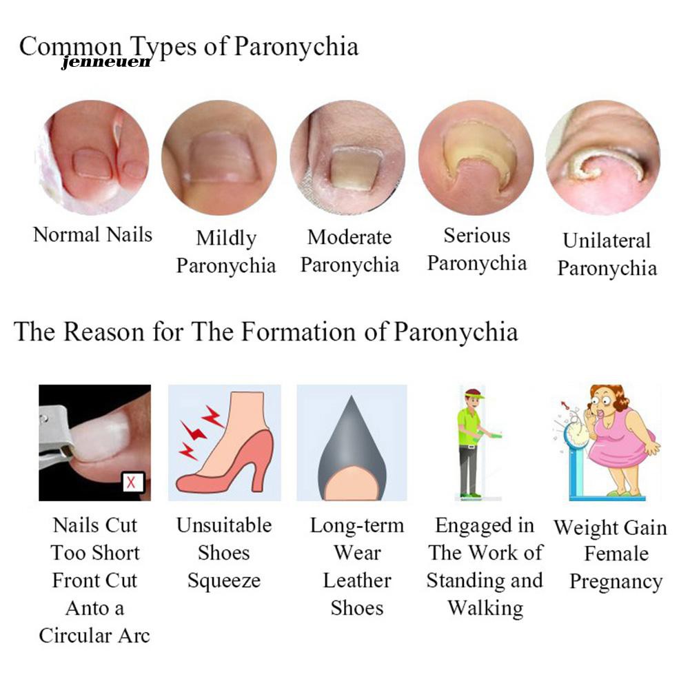 [Hàng mới về] Bộ 10 miếng dán định hình móng chân mọc ngược chất lượng cao tiện dụng 3mm/3.5mm/4mm