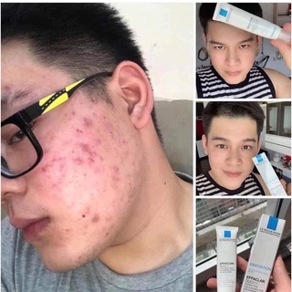 kem trị mụn