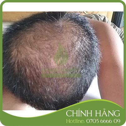 Dung dịch mọc râu tóc Minoxidil 10% Tugain