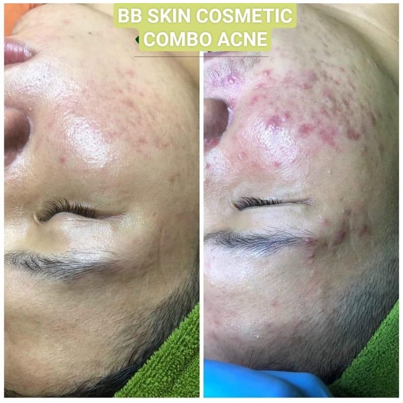 Bộ BB SKIN COMETIC Tr.i MU.n