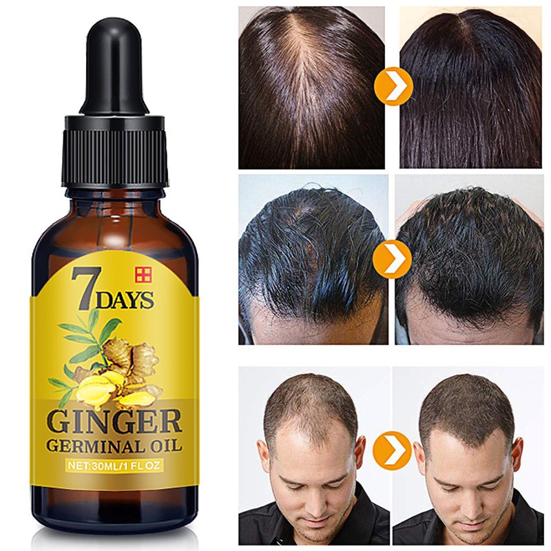 Tinh Dầu Gừng Kích Thích Mọc Tóc Hiệu Quả Trong 7 Ngày