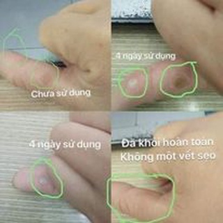 TẨY BONG MỤN CÓC NGA