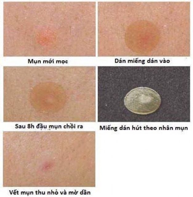 Miếng dán cho mụn Acne Pimple Master Patch