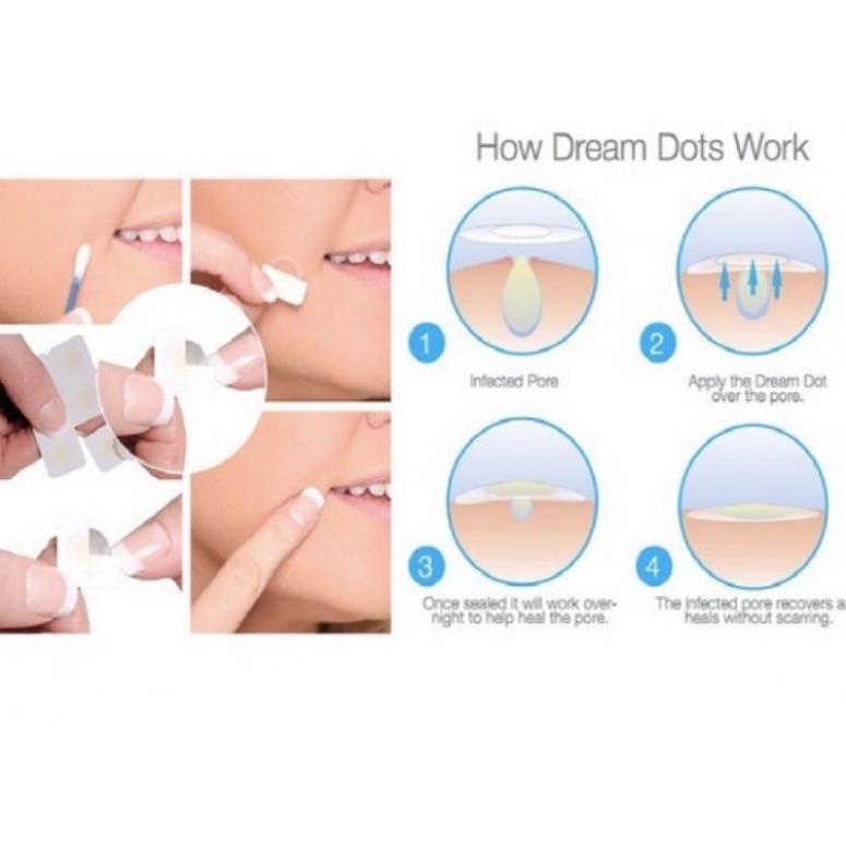 36 MIẾNG DÁN CHE MỤN, CHE KHUYẾT ĐIỂM THOÁNG KHÍ