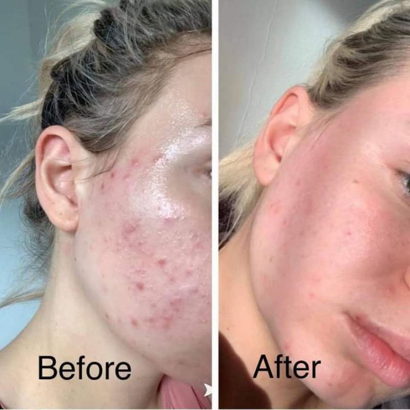 Sữa rửa mặt cho da mụn Cerave SA bản Pháp | BigBuy360 - bigbuy360.vn