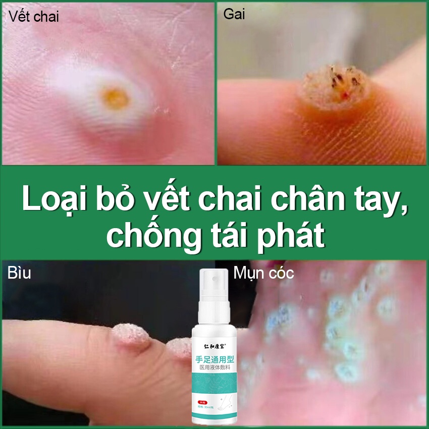 Skin tags loại bỏ mụn cóc loại bỏ mụn cơm loại bỏ chai tay chân bớt loại bỏ mụn cóc loại bỏ cholesterol kem loại bỏ mụn