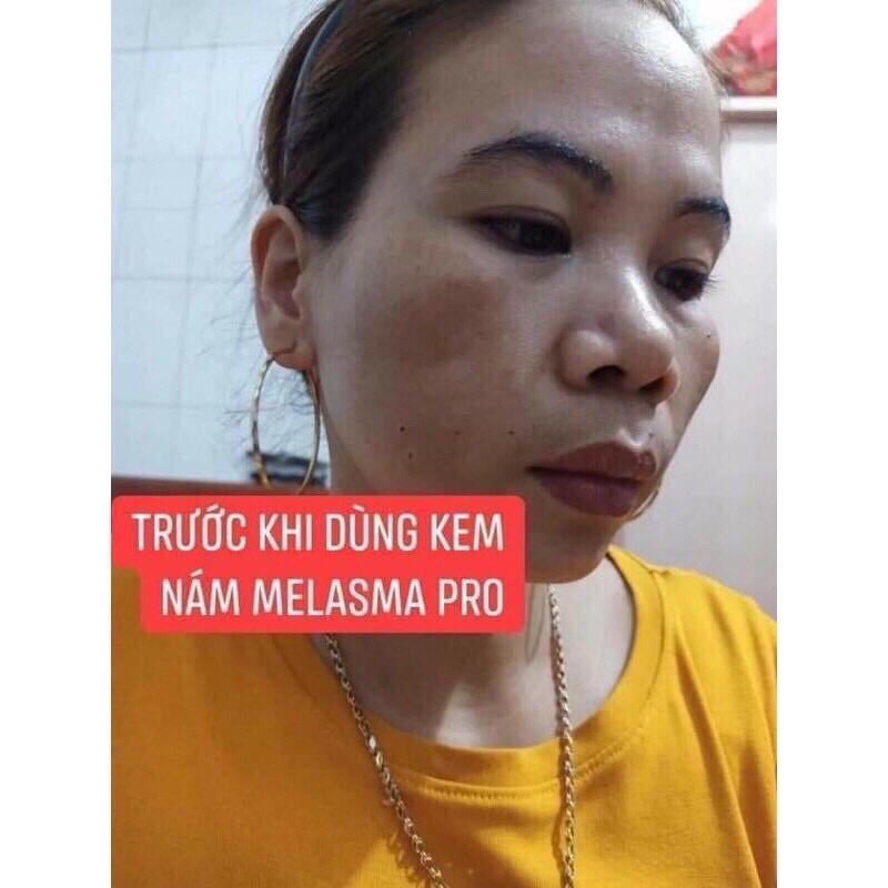 KEM NÁM PRO MELASMA PRO TRẦN KIM HUYỀN