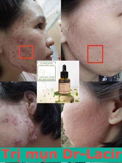 [mẫu mới] SERUM TINH CHẤT MỤN TÁI TẠO Linhzhi DR.LACIR - sạch mụn, trắng da