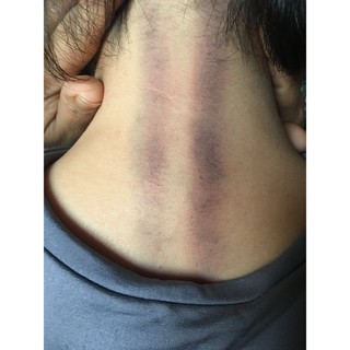 Cây bọ cạp bạc diện chẩn