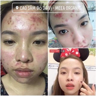 COMPO CỐT HUYẾT THANH & CAO SÂM ĐỎ MEEA