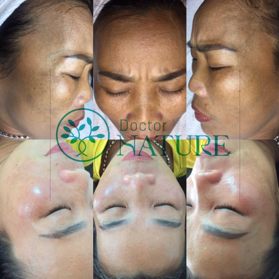 PEEL MELASMA DOCTOR NATURE