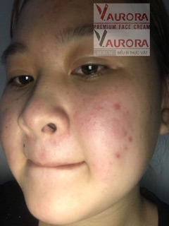 Combo Dược Mĩ Phẩm Vaurora