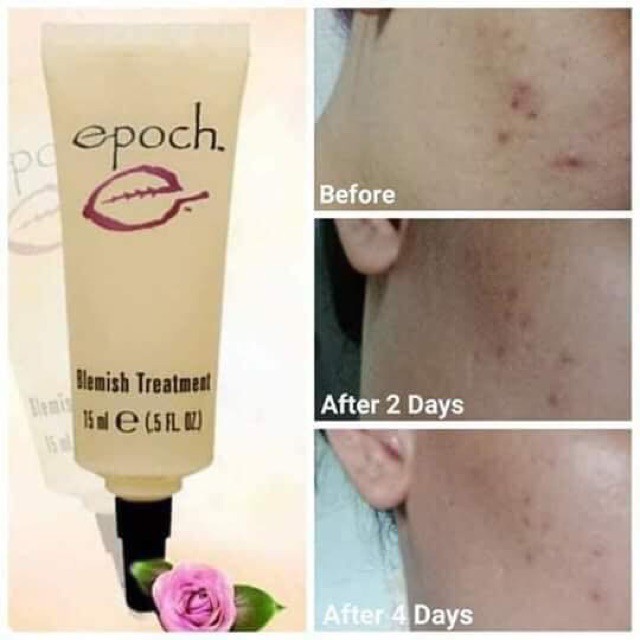 Kem giảm mụn Epoch Blemish Treatment Nuskin 15ml