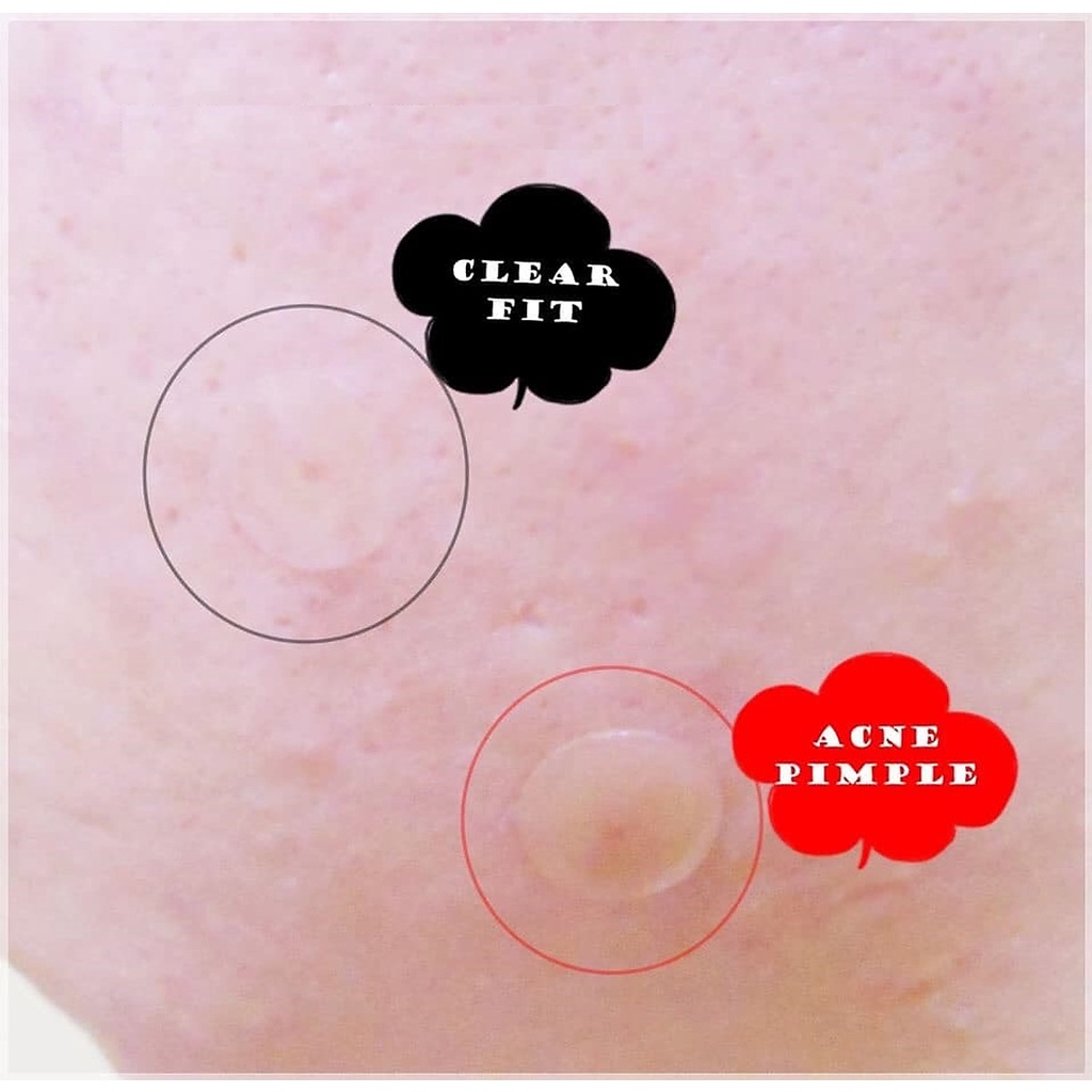 Miếng Dán Mụn COSRX Acne Pimple Master Patch