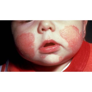 kem nẻ, chàm Glycerol Vasaline Paraffine