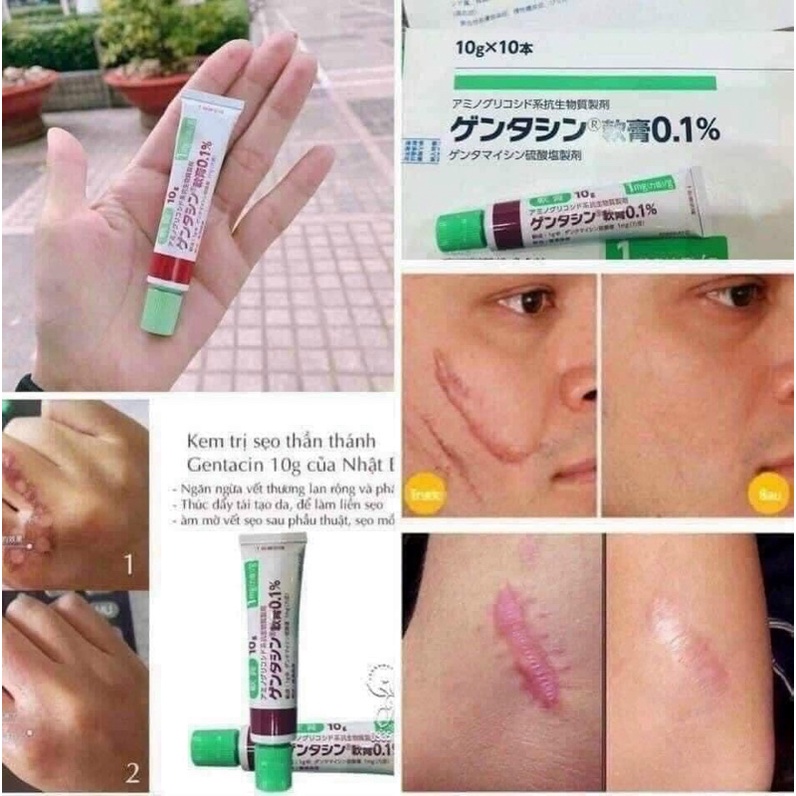 Kem Ngừa Thâm Sẹo Lồi Sẹo Lõm Gentacin