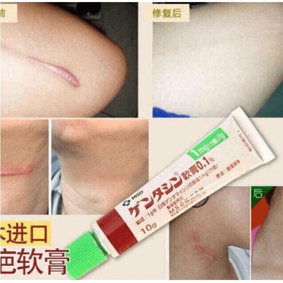 Kem sẹo bôi Gentacin Nhật Bản 10g | BigBuy360 - bigbuy360.vn