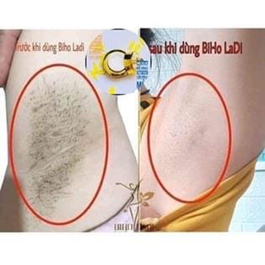 SIÊU DƯỠNG THÂM 5S BIHO LADI [COMBO 2 HỘP] (BIHO LADY KHÔNG CÒN THÂM NÁCH BẸN MÔNG BIKINI)