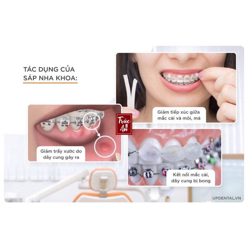 Hộp gồm 5 thanh sáp nha khoa (dài 5cm/thanh) được sử dụng để giảm đ.au và khó chịu khi đeo khí cụ niềng răng