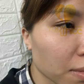 CHẤM TÀN NHANG, SẸO RỖ, MỤN RUỒI, MỤN THỊT