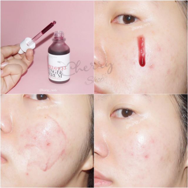 Gói dùng thử tinh chất Red Peel So's Natural Red Peed Tingle Serum 2.5ml | WebRaoVat - webraovat.net.vn