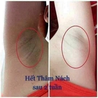 Kem Thâm Nách Qnic