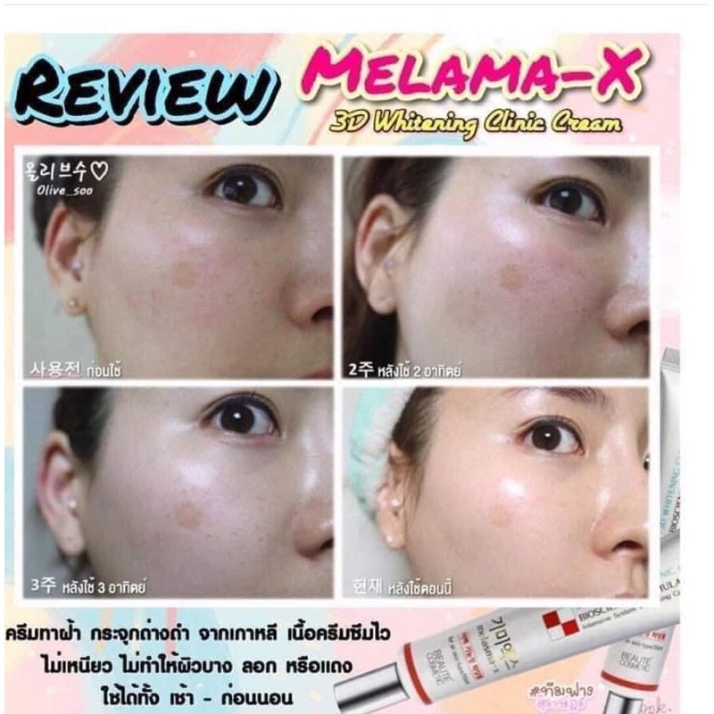 Kem Giảm Thâm Nám Và Tàn Nhang Melasma-X 3D Whitening Clinic Cream