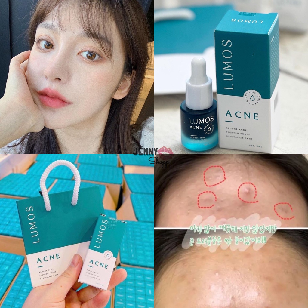 Tinh Chất Giảm Mụn Lumos Acne 5ml