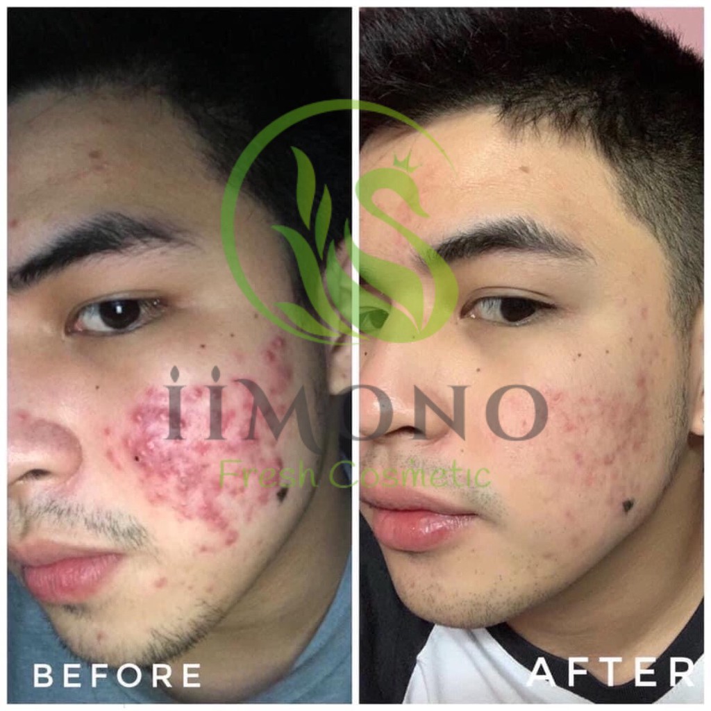 Tinh chất mụn IIMONO 6ml | BigBuy360 - bigbuy360.vn