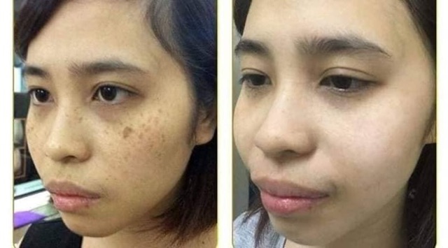 Bộ mờ nám Clobetamil G cao cấp thái lan | BigBuy360 - bigbuy360.vn